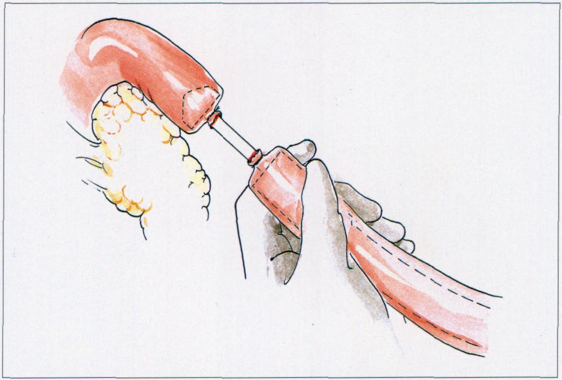 腹腔镜下肠吻合术图解图片
